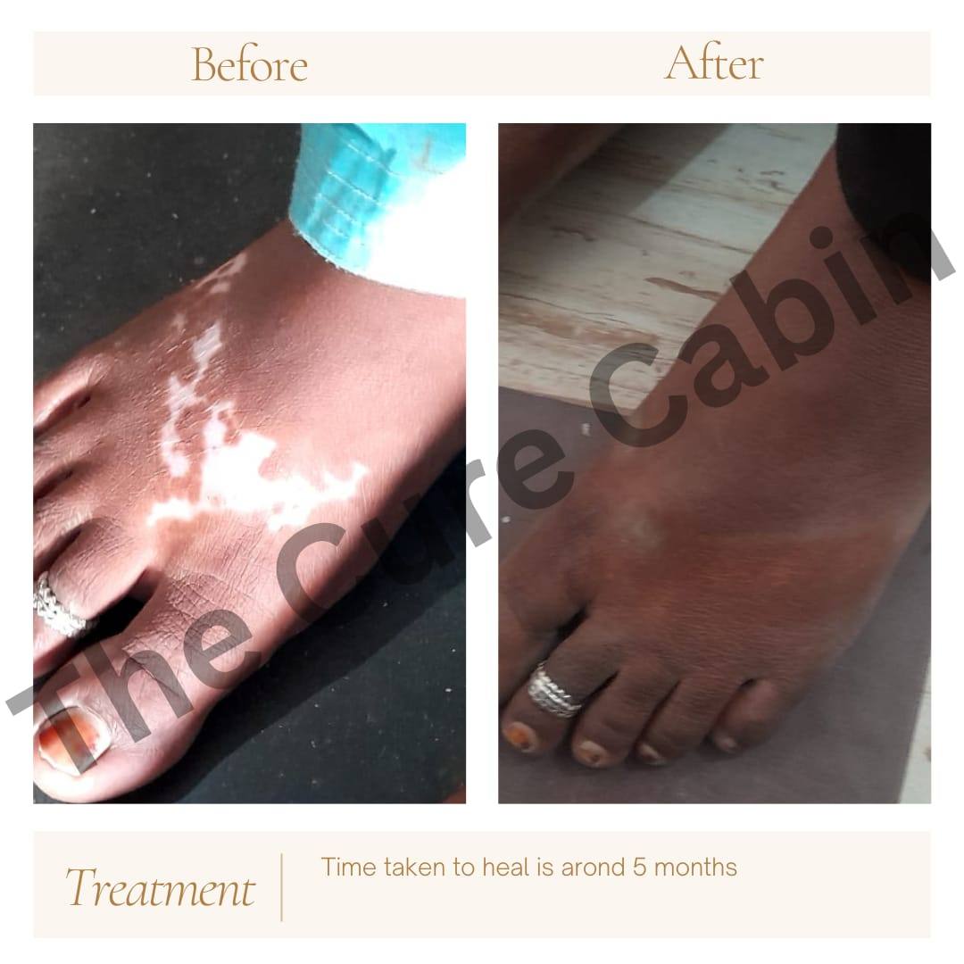 Before and after patient result