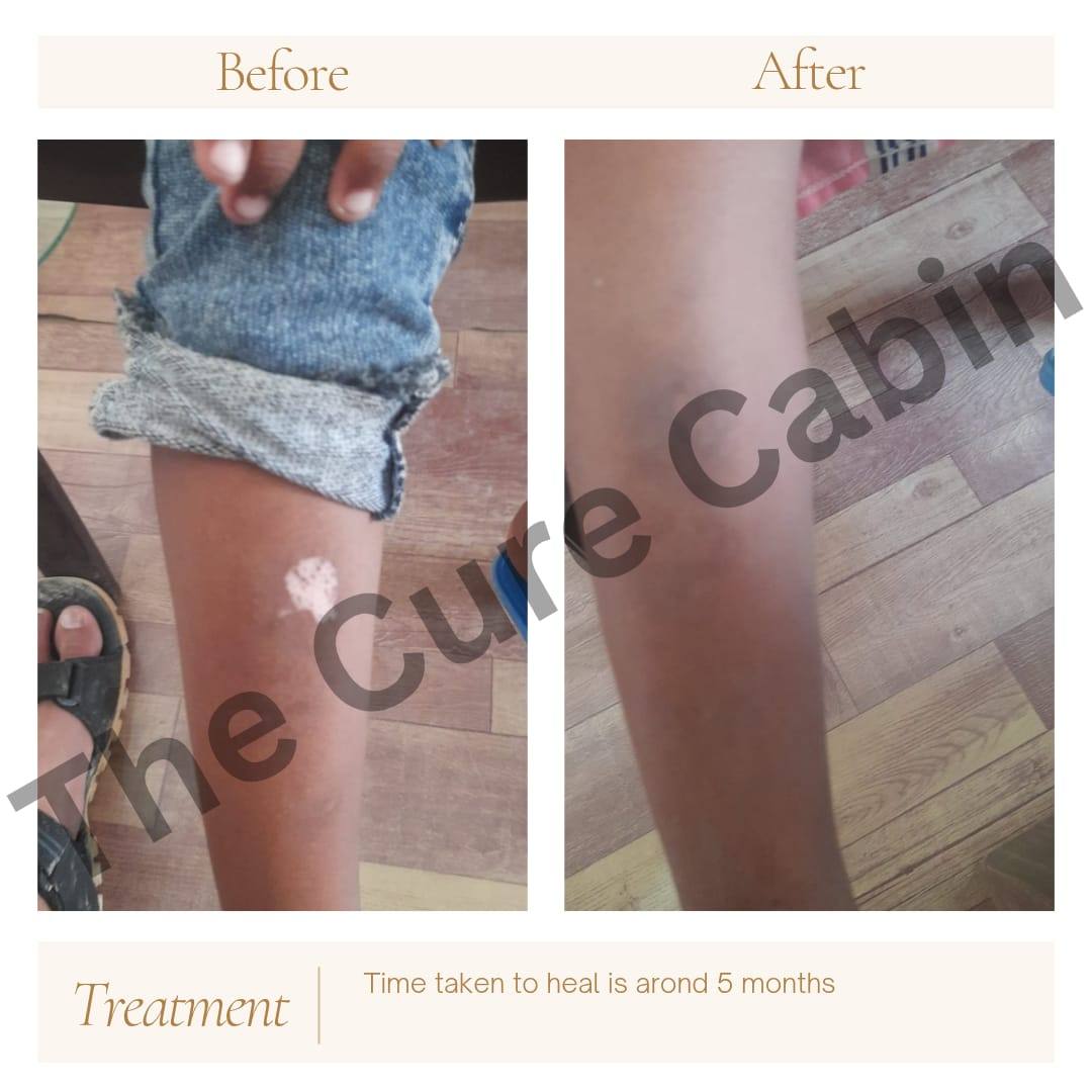 Before and after patient result